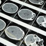 mri images of the brain